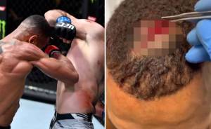 Kulit Kepala Petarung UFC Terkelupas Dihajar Sikutan Musuhnya