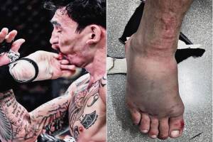 Ngeri! Wajah Petarung UFC Rusak Ditendang Kaki Musuhnya Patah