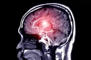 Mengenal Pendarahan Otak dan Stroke, Penyakit yang Menyerang Pelawak Tukul Arwana