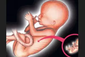 Mengenal Fetus in Fetu, Kasus Viral Bayi 5 Bulan yang Diduga Hamil